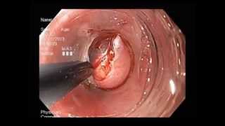 Endoscopic removal of multiple leiomyomas of the esophagus Endoscopic removal of multiple leiomyomas of the esophagus