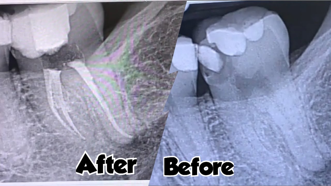 Endodontic treatment of tooth number 18 || Root canal treatment - YouTube