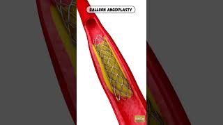 Balloon angioplasty | angioplasty | central vein balloon angioplasty | Angioplasty animation
