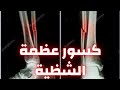 أسباب أعراض وعلاج كسر عظمة الشظية كسر عظمة الشظية دكتور احمد حسن جمعه