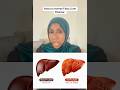This is what’s happening inside your liver #gambian #bloodsugar #mandinka #fattyliver #bellyfatloss