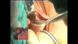 Septum Uteri   Septum Rezeksiyonu