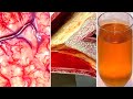 Get Rid Of 30 Lbs! Of Toxins From Your Body! Colon Cleanse and Flush Pounds of Toxins from Your Body