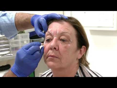 Injecting Botox into the Glabella region - Training Video For Medical Professionals Only