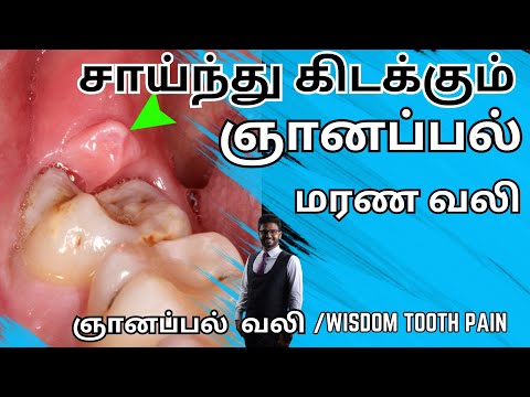 ஞானப்பல் வலி குறைய/2018/Wisdom tooth Pain in Tamil/Tooth pain relief in tamil/kadava pallu pain