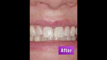 Diastema/gap closure between front teeth