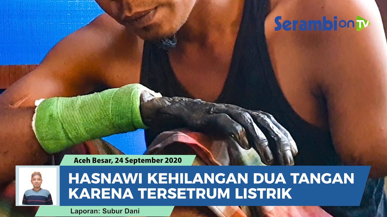 Kisah Pilu Hasnawi, Kehilangan Dua Tangan Karena Tersetrum Listrik