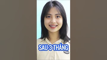 HÀNH TRÌNH  Nhật Phương thay đổi nụ cười hô, khấp khểnh của mình ?#niengrang #dentist #invisalign