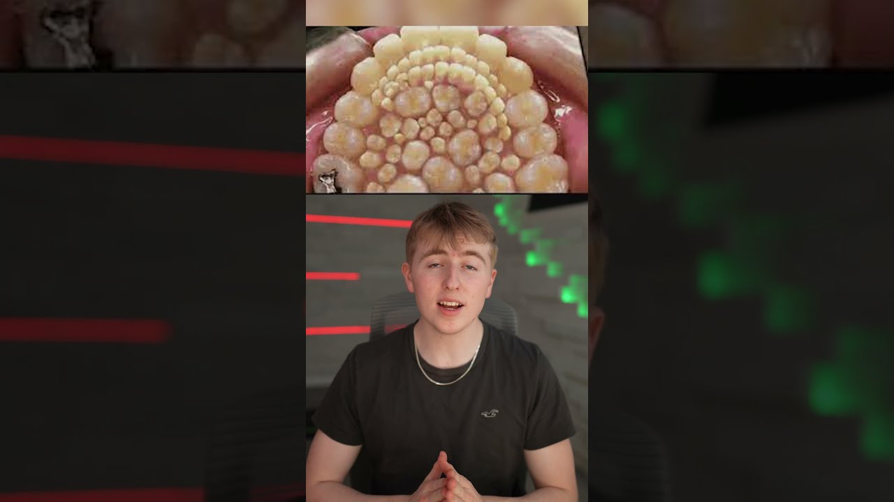This Boy Had To Get 232 Teeth Removed Shorts