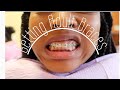 Come with me to get my Adult Braces | Braces Journey Vlog 1