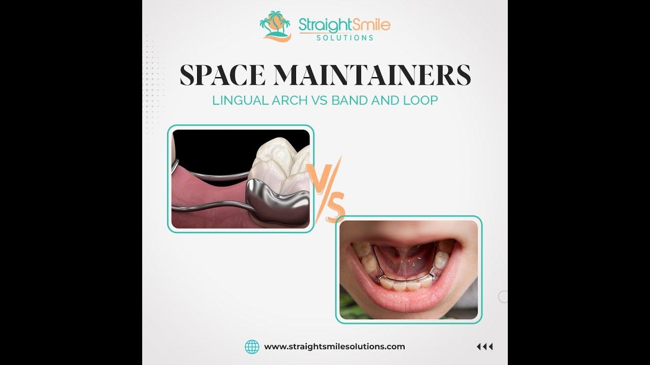 Space Maintainers Band and Loop vs Lingual Arch YouTube