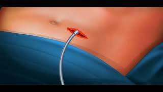(ASMR) - Surgery || kidney stone surgery || Asmr surgery animation || Asmr screenshot 5