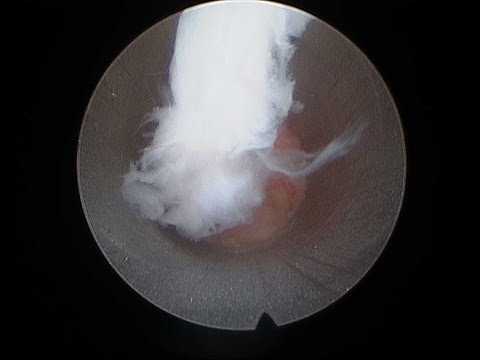 Interlaminar full endoscopic (PELD) resection disc herniation & spur removal, surgical technique. 