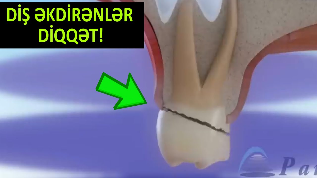 Diş əkdirənlər DİQQƏT! Çənə sümüyünüzdə problem olarsa...