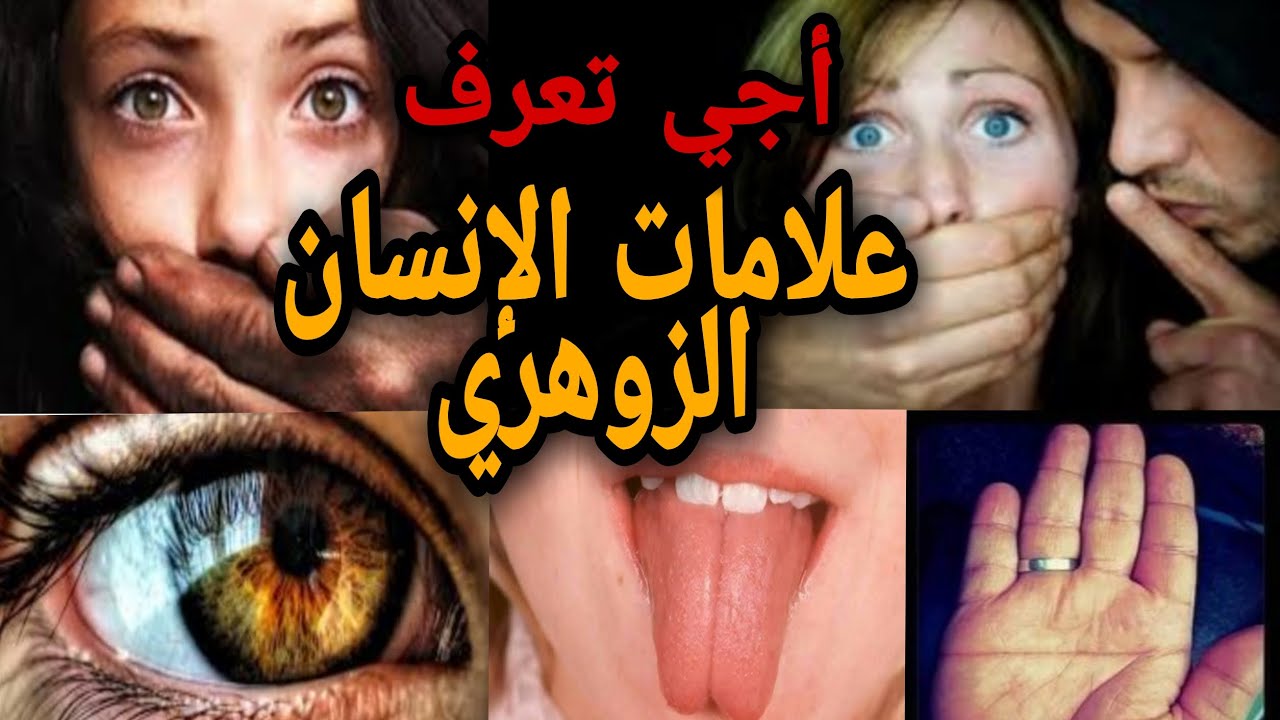 الطفل الزهري علامات اعراض الزهري