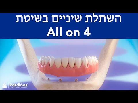 © All On 4 - השתלת שיניים בשיטת