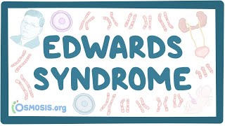 Edwards syndrome - an Osmosis Preview