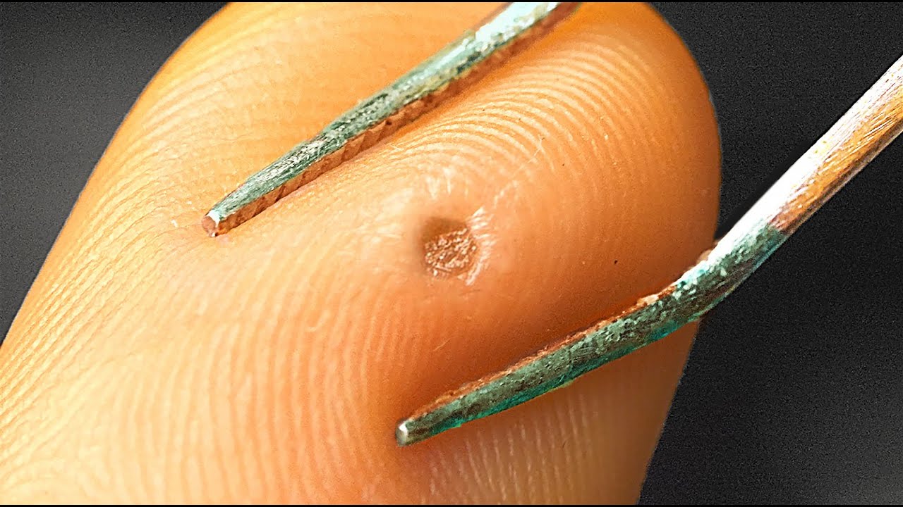 DER SCHÖNSTE PICKEL UNTER DEM MIKROSKOP! YouTube