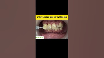 Sự thật về tẩy trắng răng mà bạn không biết I Bác sĩ Nguyễn Đình Dương