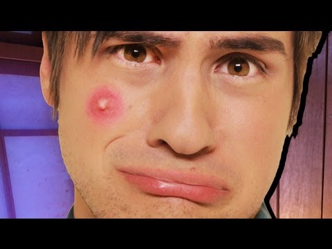 BIGGEST ZIT EVER!