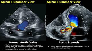 Ecocardiografia Normal vs. Estenose da Valva Aórtica | Ultrassonografia Cardíaca com Doppler Colo...