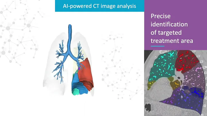 LungQ™ identification of targeted treatment area for pulmonary segmentectomy