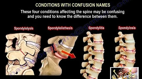 Spondylolysis, Spondylolisthesis, Spondylitis Spondylosis-Everything Need To Know-Dr. Nabil Ebraheim