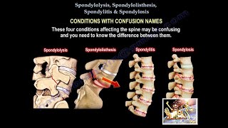 Spondylolysis, Spondylolisthesis, Spondylitis Spondylosis-Everything Need To Know-Dr. Nabil Ebraheim