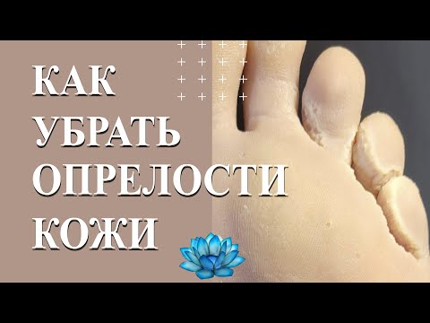 Аппаратный педикюр, когда у клиента опрелость между пальцами ног.