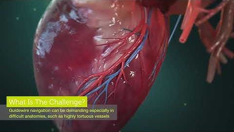 techinIQ Rotate or Retract by Corindus (3D Medical animation 2022)