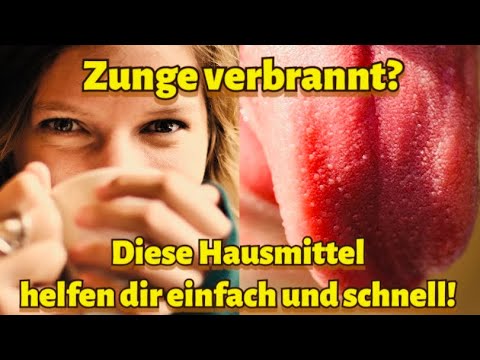 zunge-verbrannt-was-tun-zunge-verbrannt-hausmittel-zunge-und-gaumen