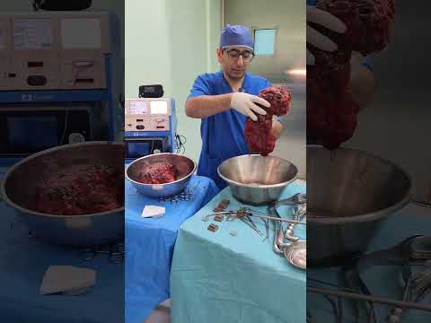 استئصال كلى عملاقة في مركز الدكتور يمان التل لجراحة اورام الكلى في الاردن