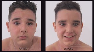 Matheus Felipe - Dermatite Atópica