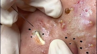 Elderly blackhead removal in CAN THO