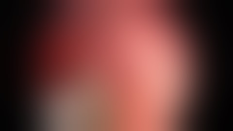 Respiratory Papillomas with the OmniGuide CO2 Laser Fiber