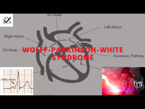 Preexcitation Syndromes: Wolff-Parkinson-White Syndrome