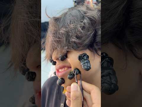 ازالة الحباية المتسلطنة م الخد       