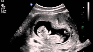 Jumping womb dancer baby ultrasound scan