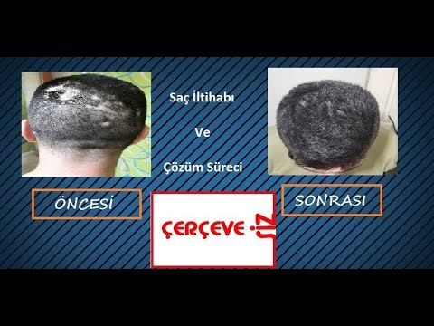 Video: Kokulu Saç Derisini Tedavi Etmenin 3 Yolu