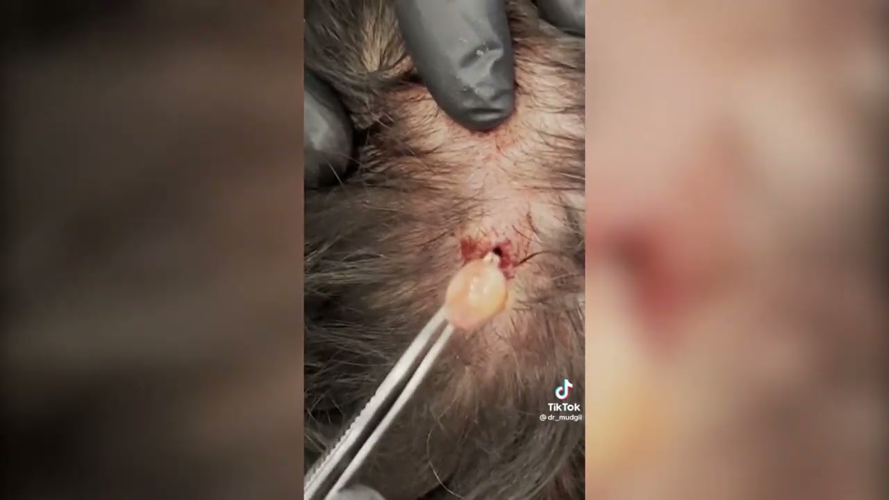 Popping huge blackheads and Pimple Popping - Best Pimple Popping Videos #56