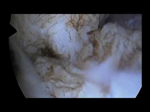 Myomectomy Hysteroscopic with Versapoint & removal by forceps - YouTube