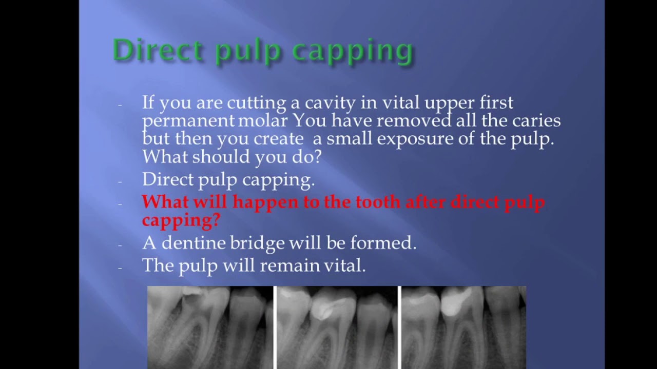 Management of  pulp exposure(MJDF,MFDS,ORE)