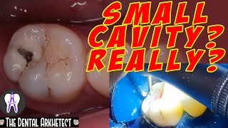 Molar Tooth Caries Removal and Restoration (Pasta sa Bagang)#42 screenshot 4