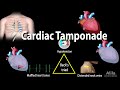 Cardiac Tamponade: Pathophysiology, Etiology, Symptoms, Diagnosis and Management, Animation