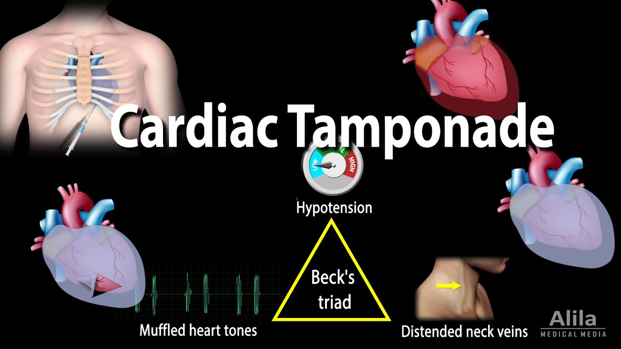 cardiac tamponade symptoms