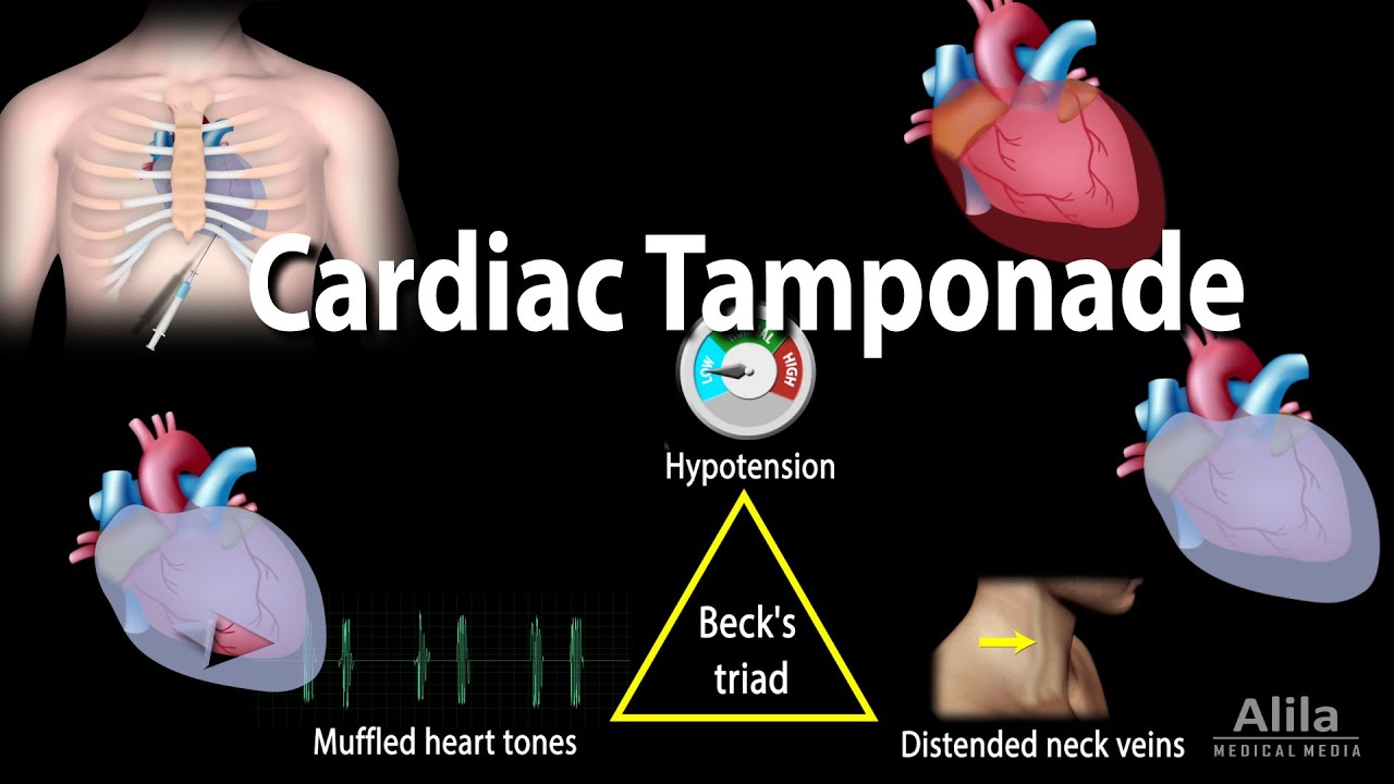 Cardiac Tamponade Procedure cardiac-tamponade-procedure