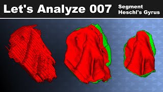 Let's Analyze E007 - Segment Heschl's Gyrus on 0.35 mm T2* weighted MRI data