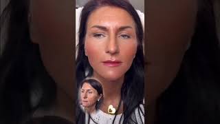 😱 Caso Surreal de harmonização facial na Touche Clinic — resultado impecável e natural! 💉✨