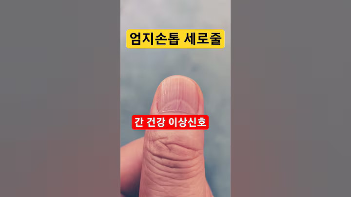 손톱 건강신호 엄지손톱 세로줄 #건강정보