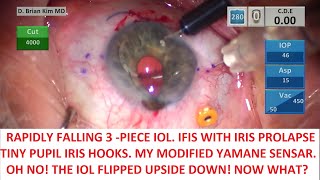 Rapidly Descending 3-Piece IOL.Tiny Pupil. IFIS. Iris Prolapse. IOL Flips Upside Down. Now What?